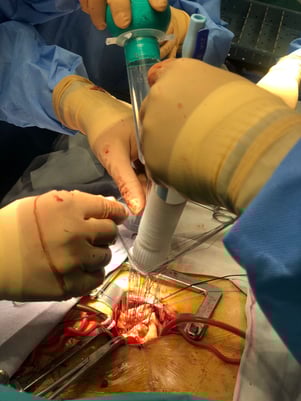 Procedimiento de Bentall por mini esternotomía