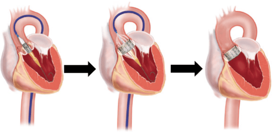 Representación de un procedimiento TAVI