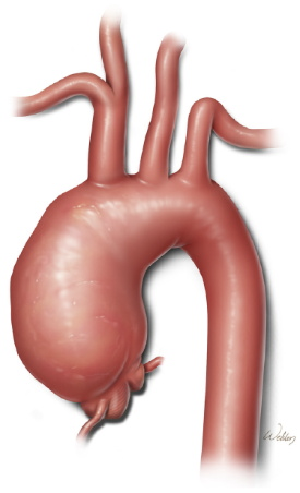 Representación gráfica de un aneurisma de la aorta ascendente