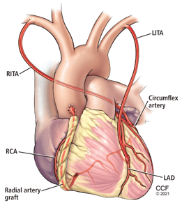 representación de una cirugía de bypass coronario