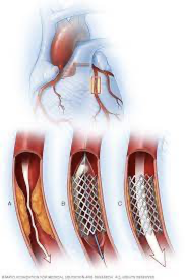 Representación gráfica de la colocación de un stent coronario