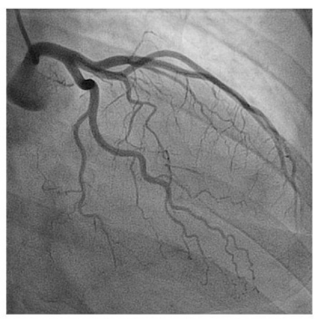 imagen de un cateterismo cardiaco