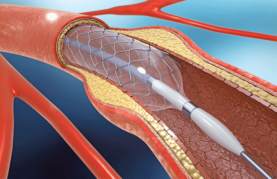 representación de la colocación de un Stent coronario