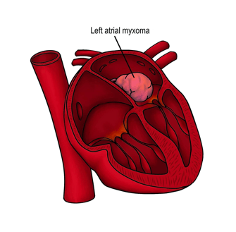 Representación gráfica de un mixoma cardiaco
