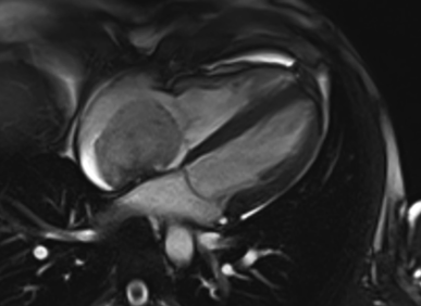 resonancia magnética revelando un tumor de corazón