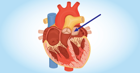 Gráfico de tumor cardiaco 