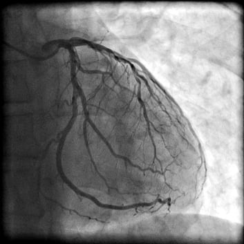 imagen de un cateterismo cardiaco
