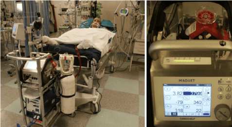 Paciente en Terapia Intensiva conectado a ECMO