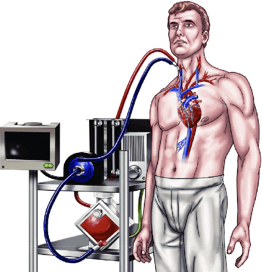 Representación gráfica de paciente despierto conectado a ECMO