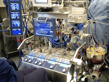 máquina de derivación cardiopulmonar