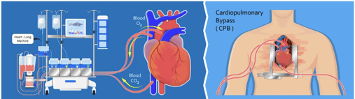 Representación gráfica de una conexión del paciente a la máquina de bypass cardiopulmonar