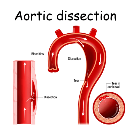 representación de la disección aórtica