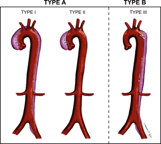 disección de la aorta