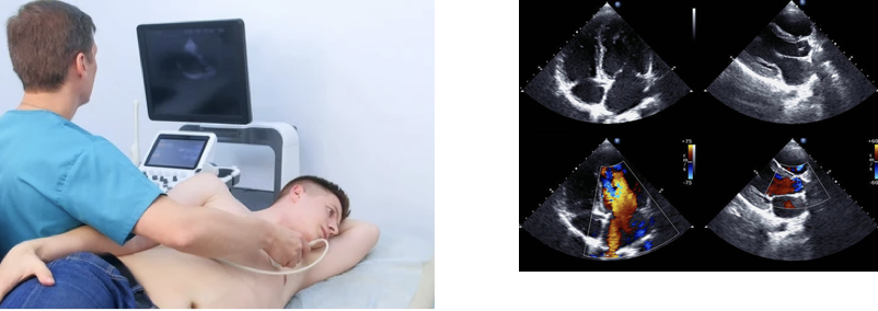 ecocardiograma