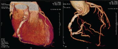 Representación de angio tomografía cardiaca