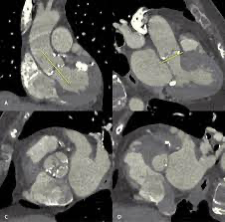CT Scan of Heart