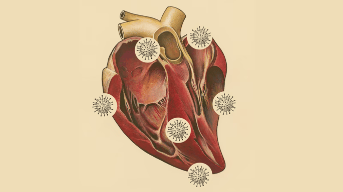 Representación de la afección cardiaca por COVID-19