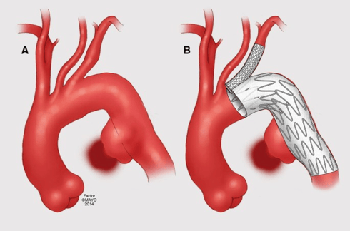 Tratamiento endovascular de aneurisma