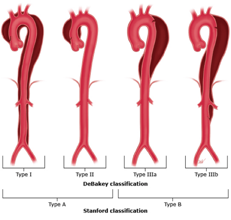 Clasificación de disección aórtica