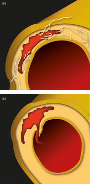 hematoma intramural y ùlcera aórtica