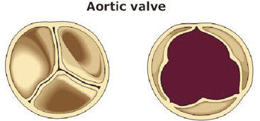 Válvula aórtica normal vista desde arriba en posición cerrada y abierta