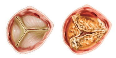 Representación de una válvula aórtica enferma calcificada