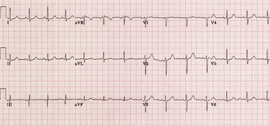 ejemplo de un electrocardiograma