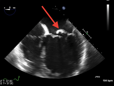 ecocardiograma con vegetación en la válvula mitral