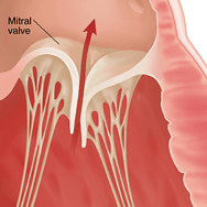 Insuficiencia de la válvula mitral