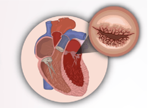 representación de una estenosis mitral reumática