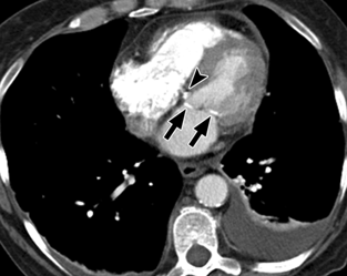 Tomografía del corazón revelando calcificación en la válvula mitral
