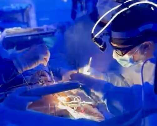 Video donde se discuten los detalles de la cirugía de corazón por mínima invasión