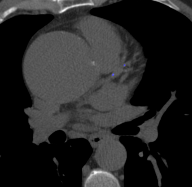 Angio TAC mostrando un aneurisma de aorta ascendente