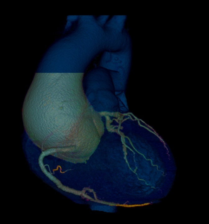 Reconstrucción 3D de un aneurisma de aorta ascendente