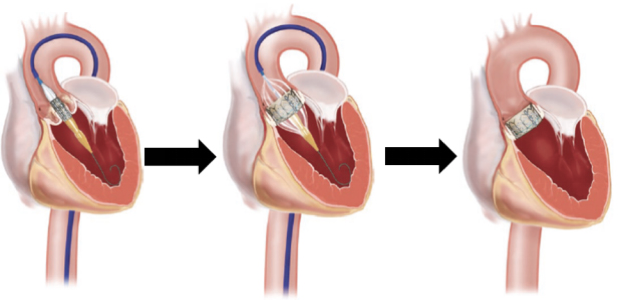 Gráfico demostrando el procedimiento de implante de válvula trans catéter