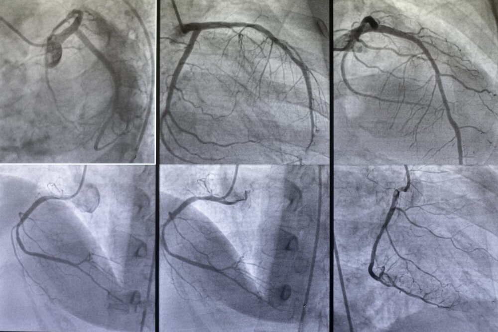 Angiografías coronarias mostrando arterias del corazón