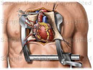 Ilustración de intervención quirúrgica cardíaca