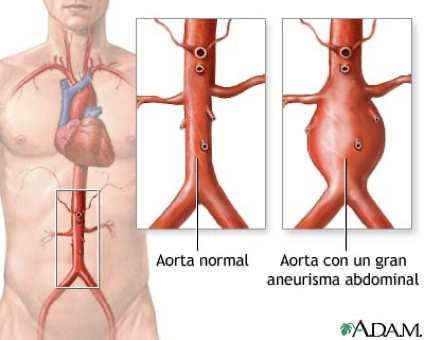 Aneurisma de la aorta abdominal