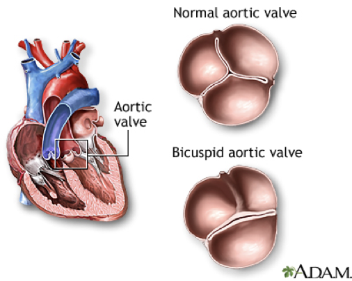 Gráfico comparando una válvula aórtica normal y un bicúspide