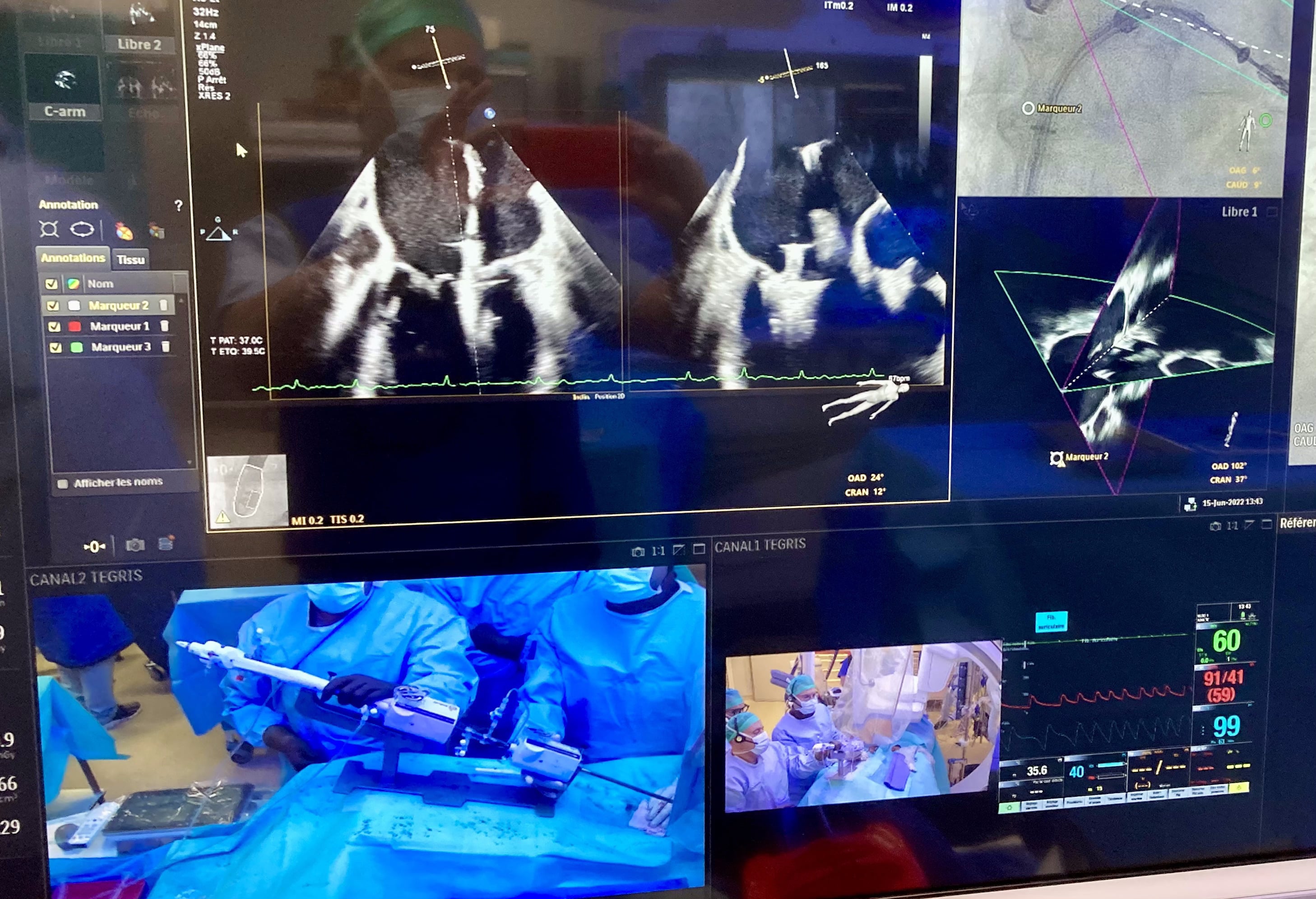Monitor de ecocardiografía durante la evaluación de un caso de MitraClip